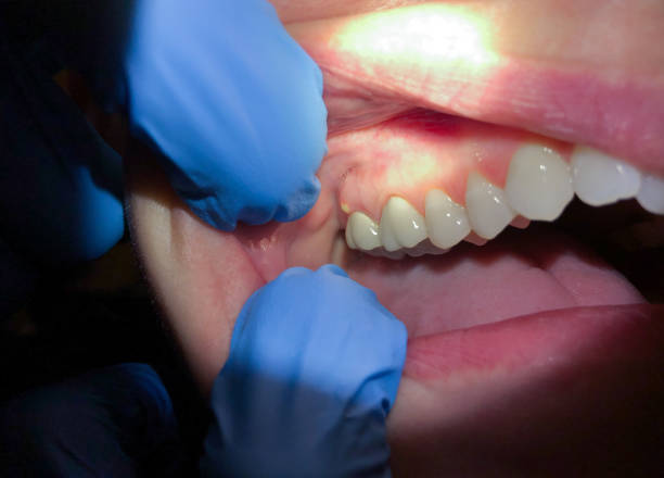 Best Teeth Whitening  in Spring Lake, NC