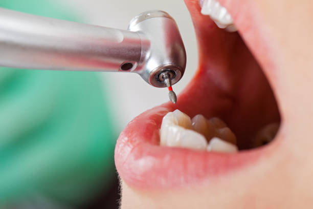 Best Emergency Dental Filling Replacement  in Spring Lake, NC